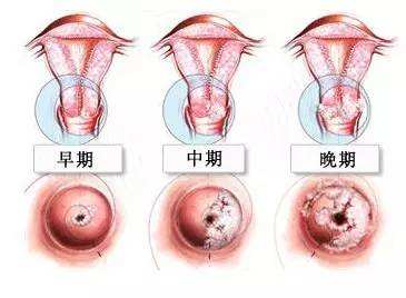 郑州治疗宫颈糜烂去哪家医院好